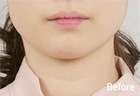 ภาพก่อนและหลังทำ Contour Tox 4 แบบเพื่อผลลัพธ์ V-line