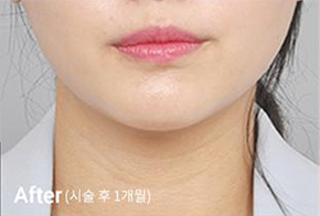 ภาพก่อนและหลังทำ Contour Tox 4 แบบเพื่อผลลัพธ์ V-line