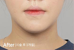 ภาพก่อนและหลังทำ Contour Tox 4 แบบเพื่อผลลัพธ์ V-line