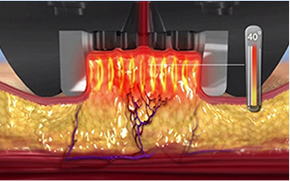 ภาพแสดงผลของโหมด InMode FX ต่อชั้นผิว