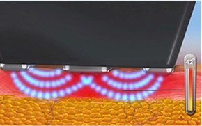 ภาพแสดงผลของโหมด InMode FORMA ต่อชั้นผิว