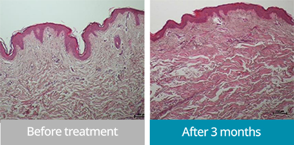 ภาพก่อนและหลังทำ ONDA lifting - ผลลัพธ์ของการกระตุ้นคอลลาเจนเพื่อยกกระชับและเพิ่มความยืดหยุ่นของผิว