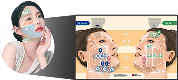 อธิบายประเภทของหัว Ulthera ที่ออกแบบให้เหมาะกับแต่ละส่วนของใบหน้า เช่น คิ้ว ข้างดวงตา ใต้ตา แก้ม และคอส่วนบน