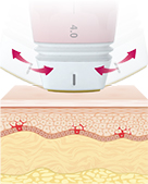 หัวทิปเอียงออกแบบเพื่อยกกระชับเฉพาะจุดบนใบหน้าอย่างแม่นยำ