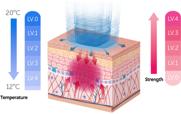 การยกกระชับผิวที่ปกป้องผิวด้วยระบบไฮโดรคูลลิ่งและระดับการสั่นสะเทือน ลดระยะเวลาพักฟื้น