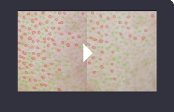 ภาพเปรียบเทียบขนาดรูขุมขนหลังทำ Rejuran Healer 4 สัปดาห์