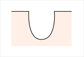 รูปแบบต่างๆ ของรูขุมขนและแผลเป็น - น้ำแข็งเจาะ, จานกลม, กล่อง