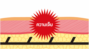 คำอธิบายเกี่ยวกับการกระตุ้นเส้นประสาทจากเงี่ยงของไหมที่ติดอยู่หลังการยกกระชับทั่วไป