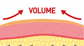คำอธิบายเกี่ยวกับกลไกของ Silhouette Soft ที่ช่วยลดการกระตุ้นเส้นประสาทด้วยกรวยที่เคลื่อนย้ายได้